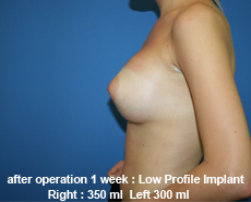 plastic-surgery-breast-augmentation